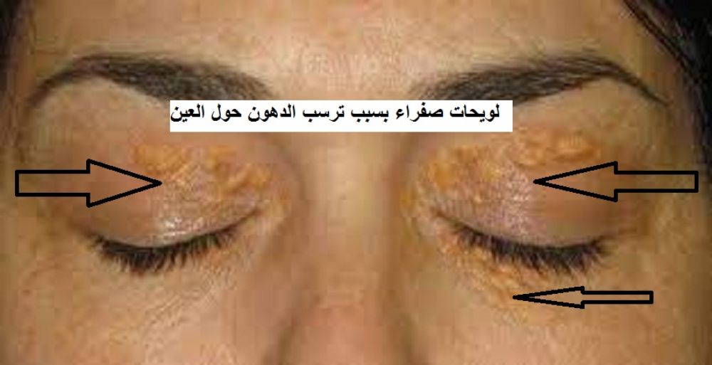 علاج الترسبات الدهنيه (الكوليسترول) الصفراء  حول العين بالاعشاب والطب البديل