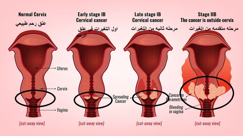 فيروس الورم الحليمي البشري